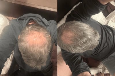 Customer photo review of Peptide Infusion Hair Regrowth System