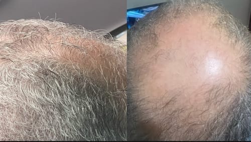Customer photo review of Peptide Infusion Hair Regrowth System