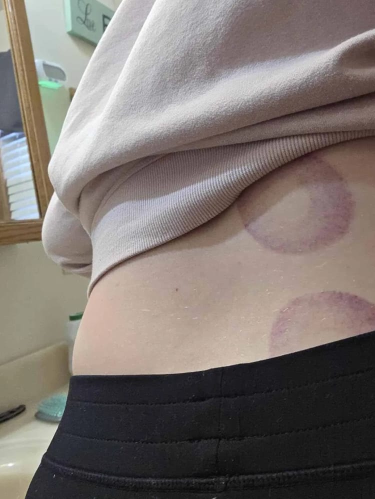 Customer photo review of VORA™ Terapia con Ventosas Inteligentes