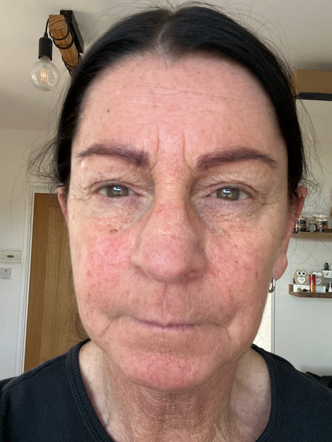 Customer photo review of ZO Redness Relief + Barrier Defense Program For Red, Sensitized Skin
