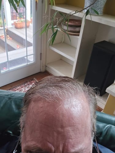Customer photo review of Peptide Infusion Hair Regrowth System