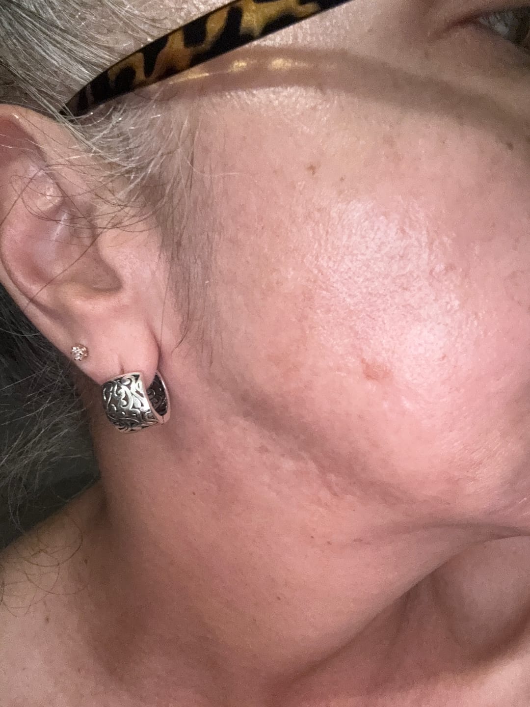 Customer photo review of Hyaluronic Acid with Epidermal Growth Factor 💦