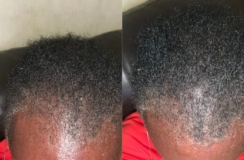Customer photo review of Peptide Infusion Hair Regrowth System