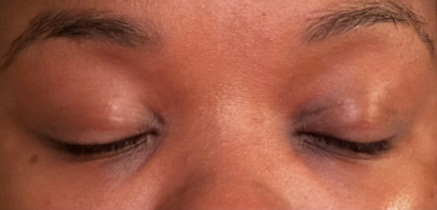 Customer photo review of Glutathione kojic acid eye patch Vita jelly