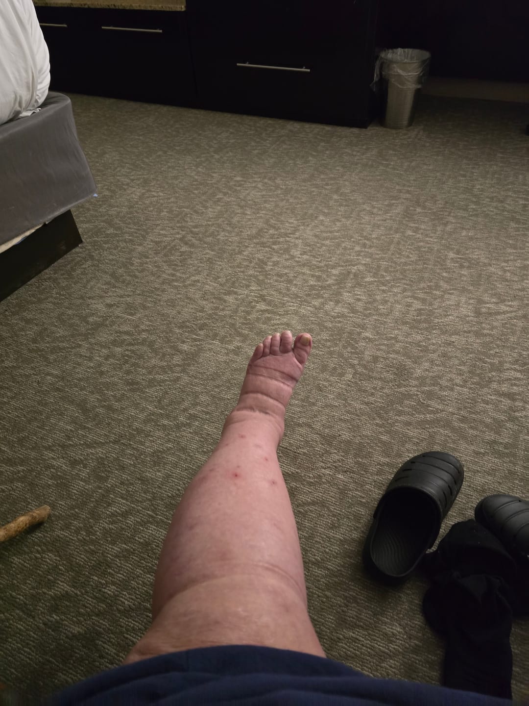 Customer photo review of EverSock™ Bamboo Open Toe Compression Socks