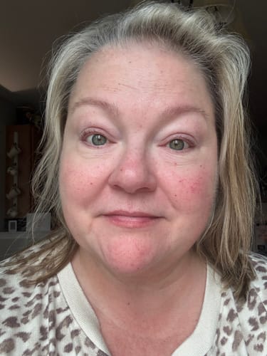 Customer's face showing results after three treatments with The Micro Infusion System.