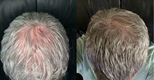 Customer photo review of Peptide Infusion Hair Regrowth System