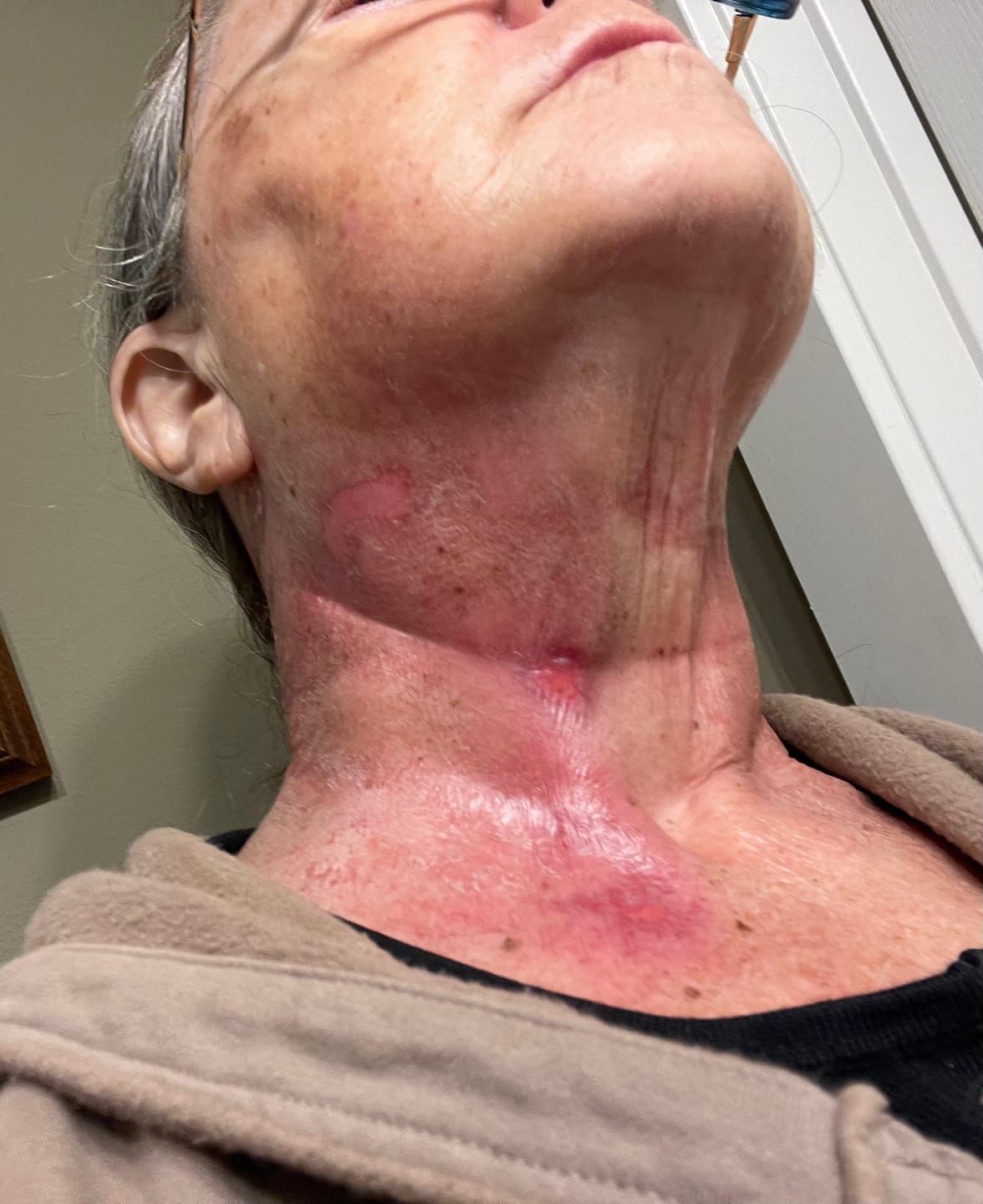 Customer photo review of Hand-Foot Syndrome Cream for Chemo-Related Skin Problems
