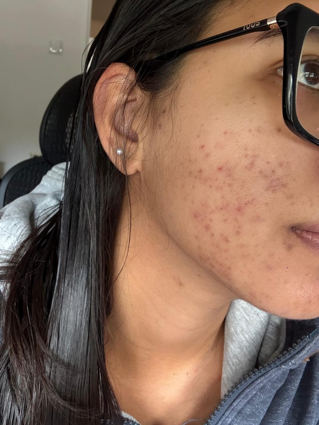 Customer photo review of A CONTROL - ACNÉ HORMONAL & RESISTENCIA A LA INSULINA