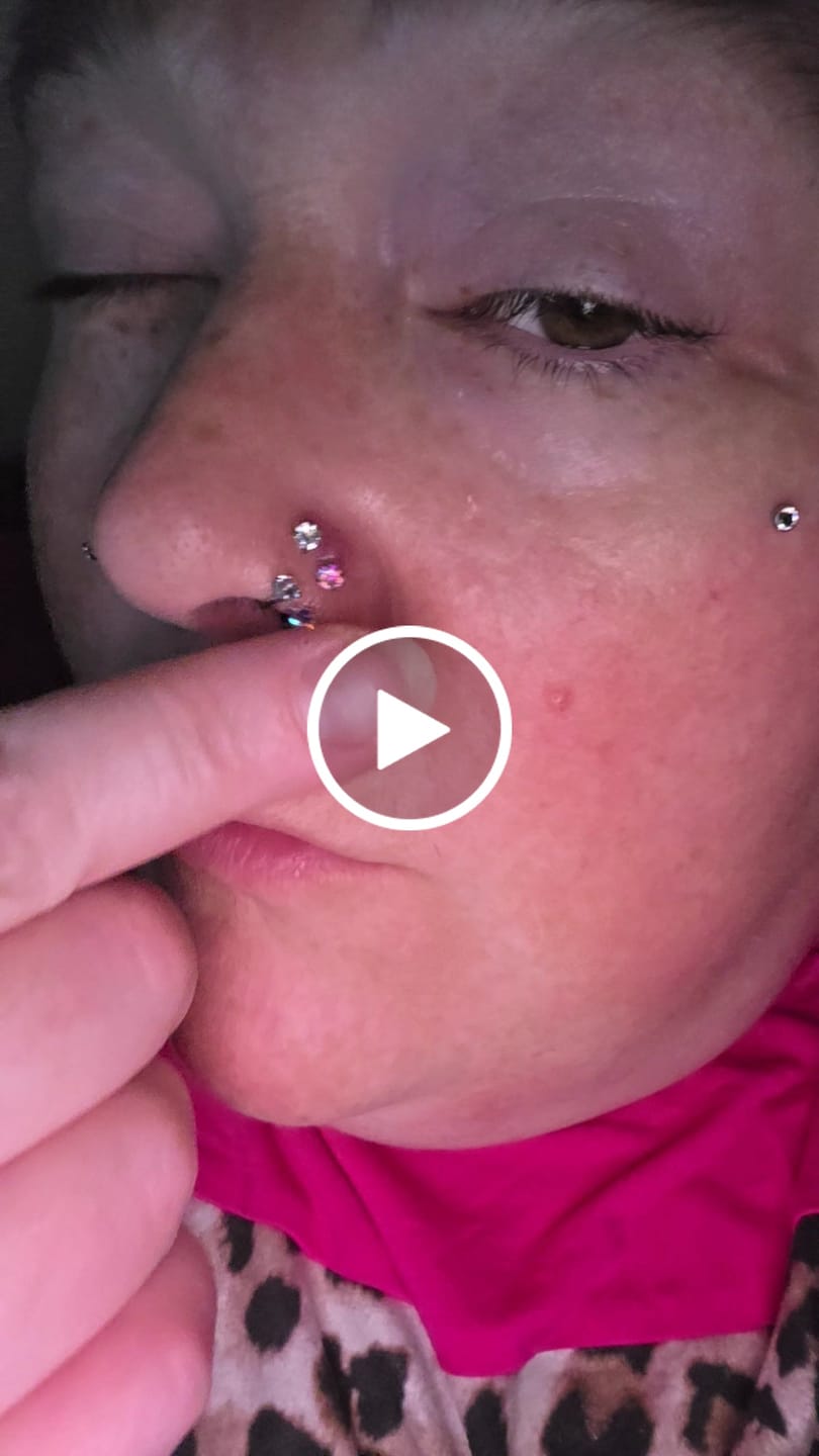 Customer video review of Piercing Bump Emergency Trio
