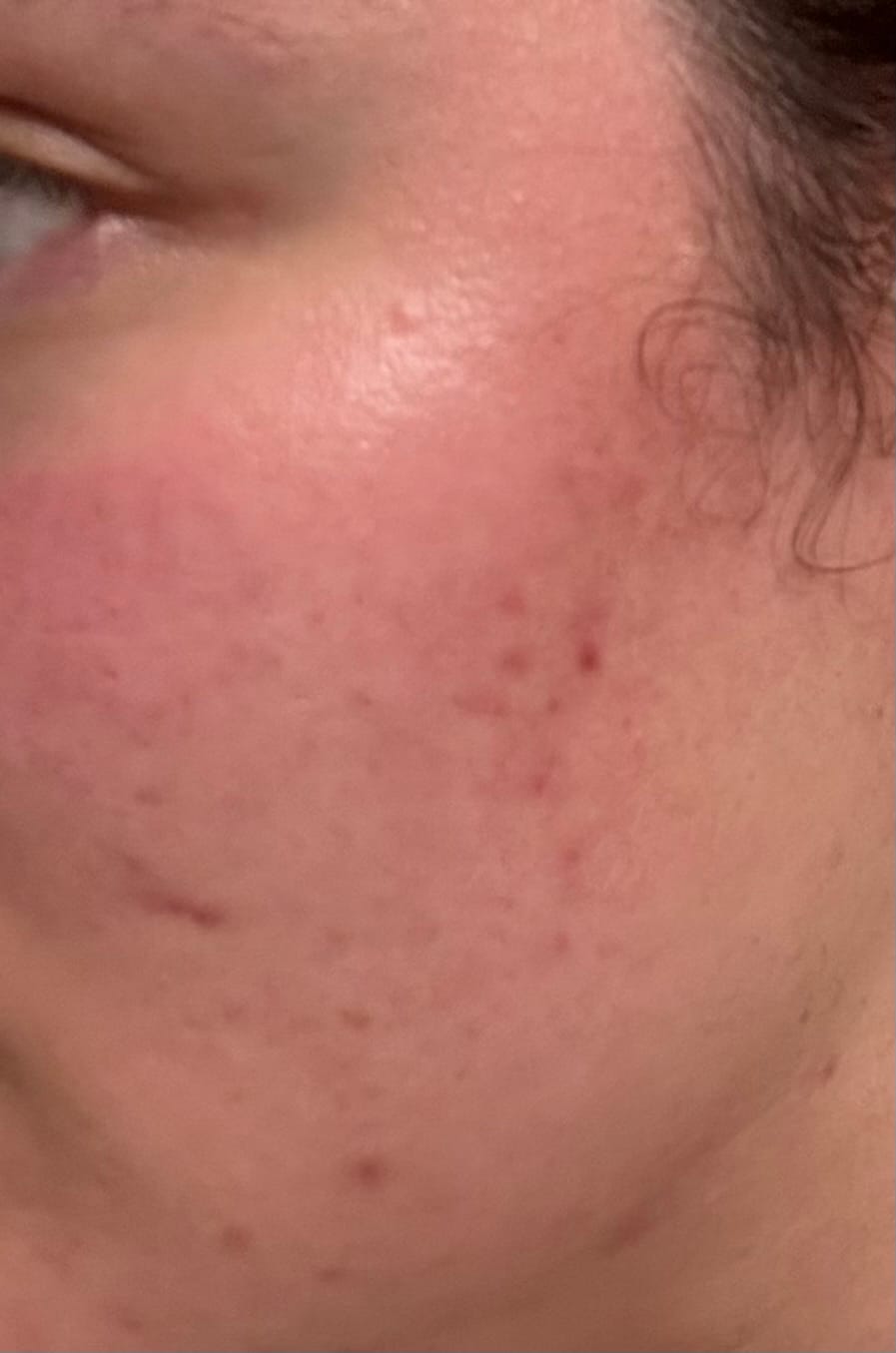 Customer photo review of A CONTROL - ACNÉ HORMONAL & RESISTENCIA A LA INSULINA