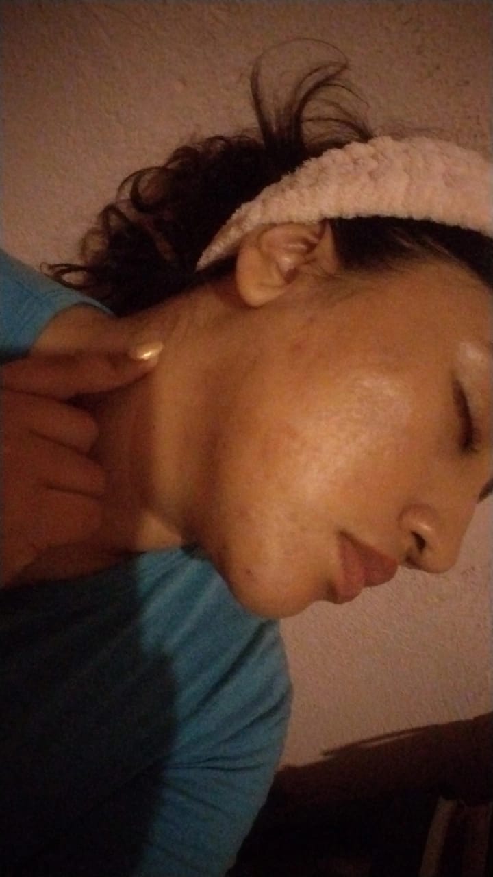 Customer photo review of Loción para el tratamiento del acné con ácido salicílico-3 piezas