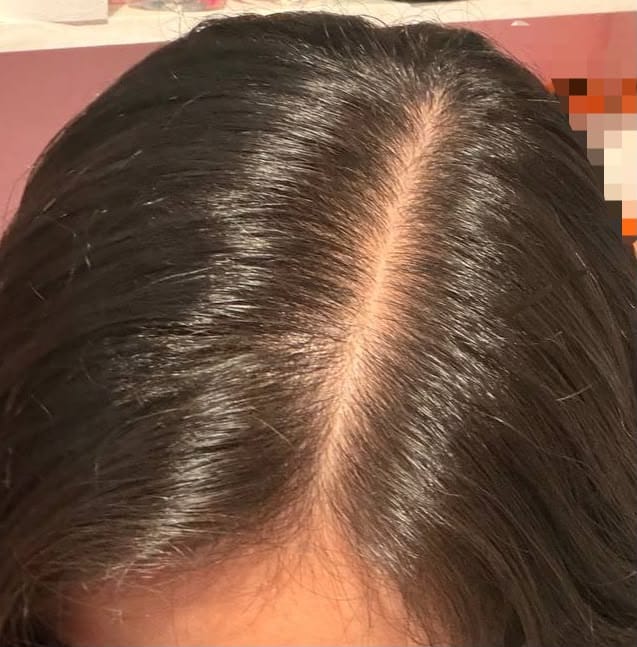Customer photo review of Minoxidil 1 mg con 90 tabletas para 3 meses de tratamiento