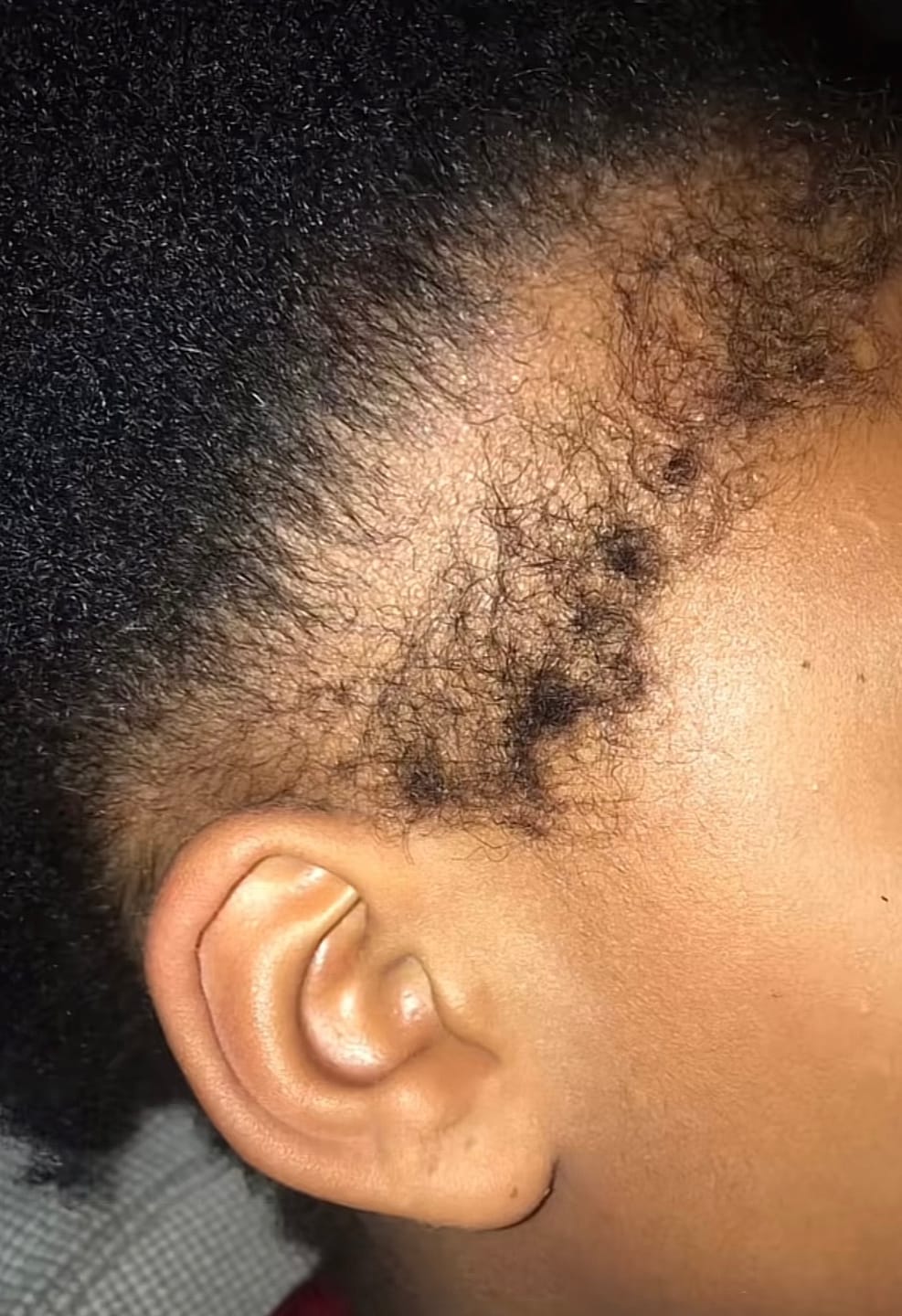 Customer photo review of Minoxidil 5% SOLUTION, 3 x 60ml pack