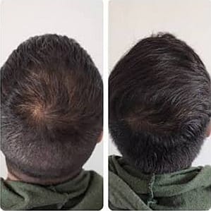 Customer photo review of Tónico Capilar de Romero  · Crecimiento y Anticaída