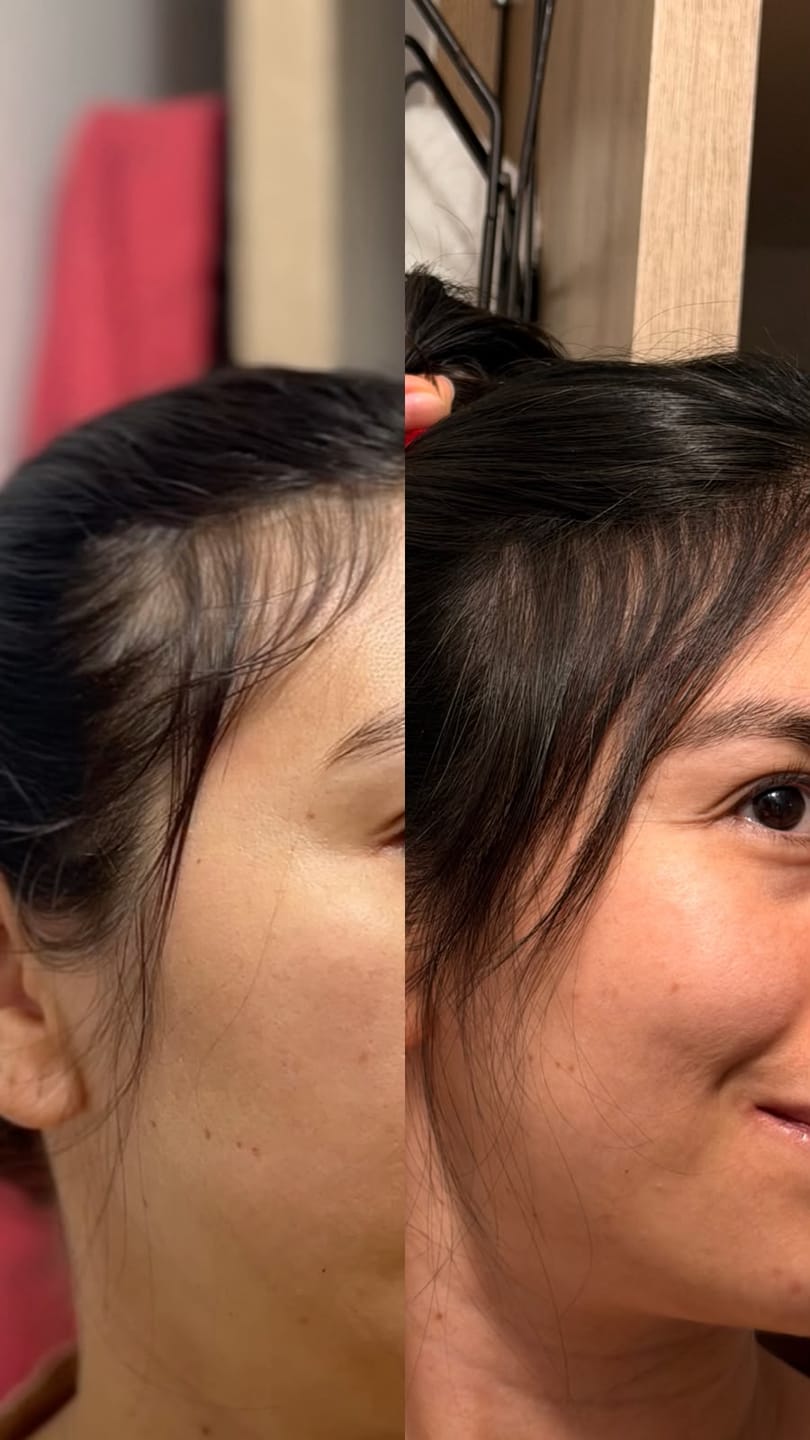 Customer photo review of 3 Tónicos Capilares de Romero · Crecimiento y Anticaída + Dermaroller de regalo