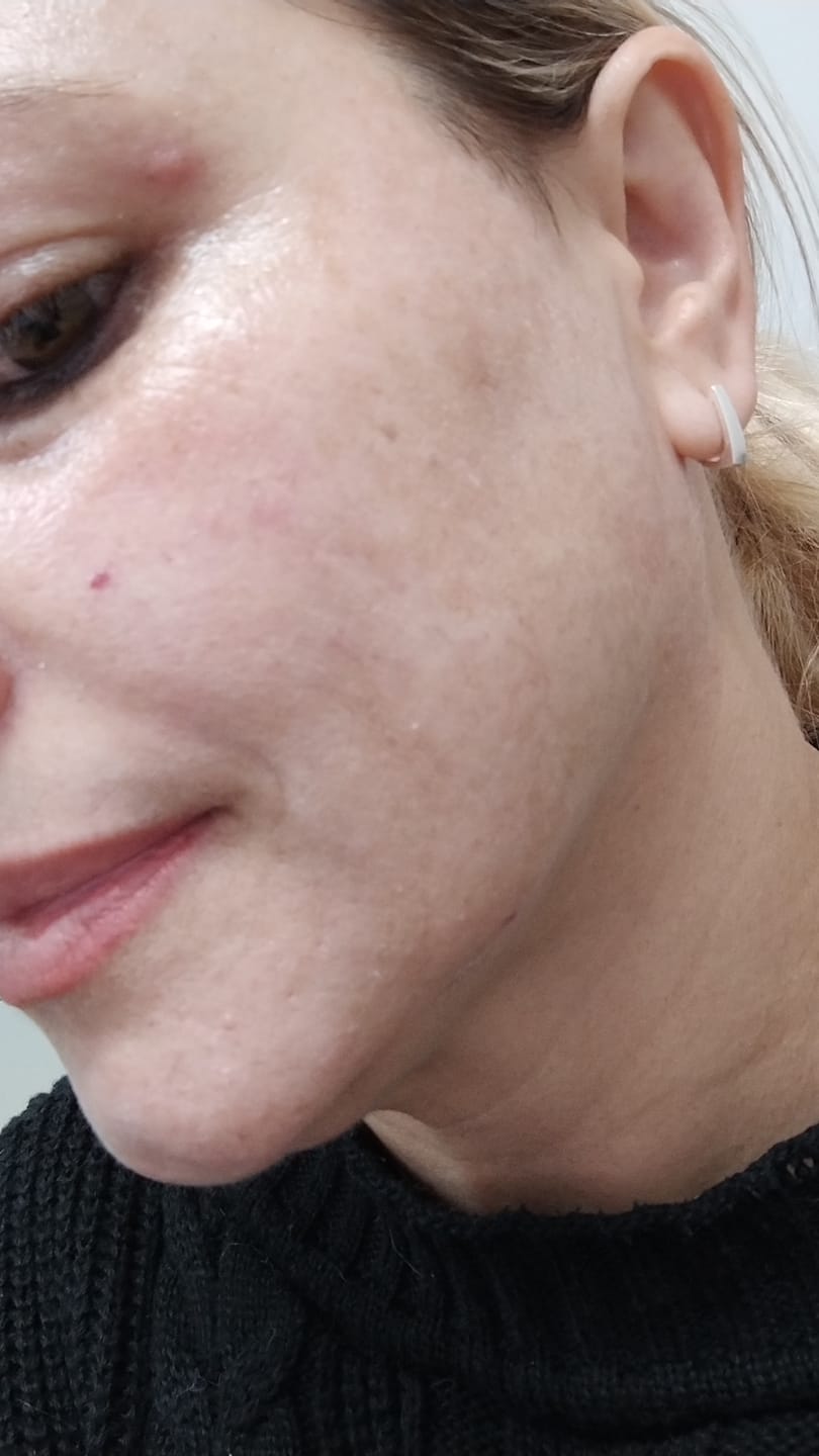 Customer photo review of Creme Clareador de Manchas – Melasma, Axilas, Virilha, Áreas Íntimas, Rosto e Corpo