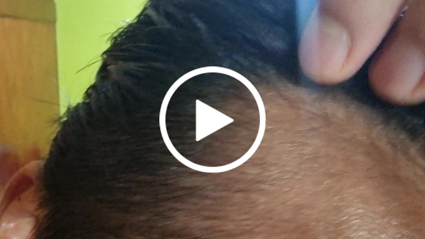 Customer video review of Minoxidil 5 mg con 90 tabletas para 3 meses de tratamiento