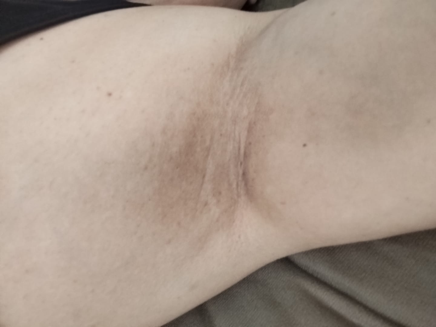 Customer photo review of Creme Clareador de Manchas – Melasma, Axilas, Virilha, Áreas Íntimas, Rosto e Corpo