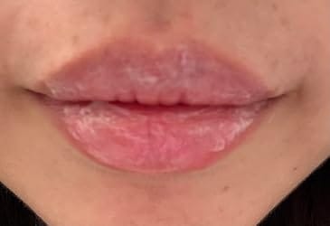 Customer photo review of ChillPlump™ Lip Mask