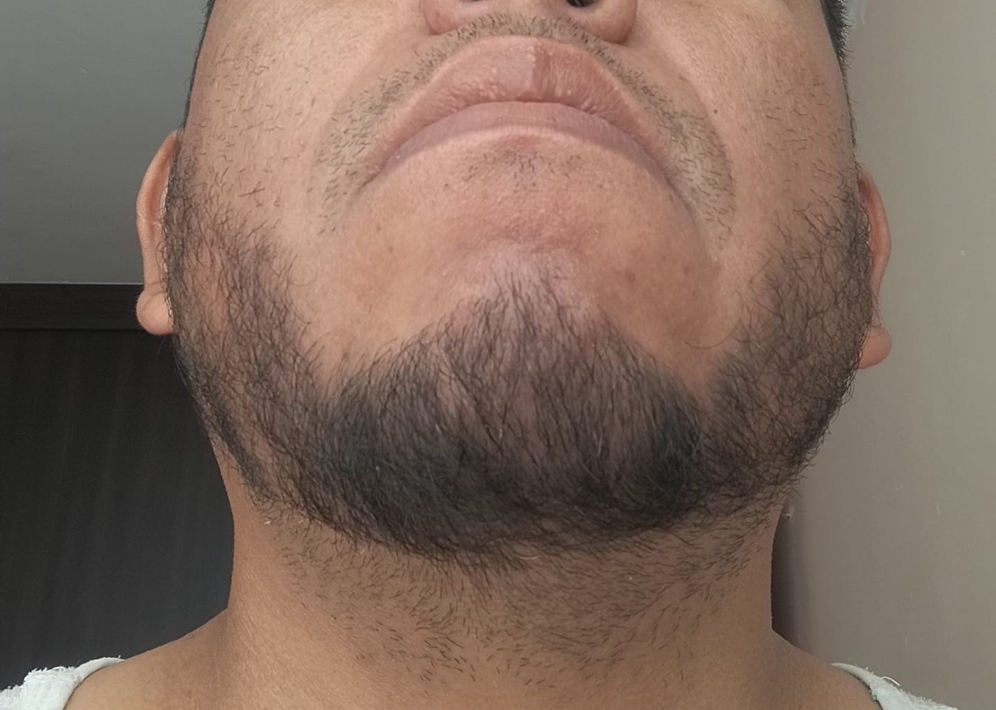 Customer photo review of Bálsamo Mélamus - Minoxidil 20%