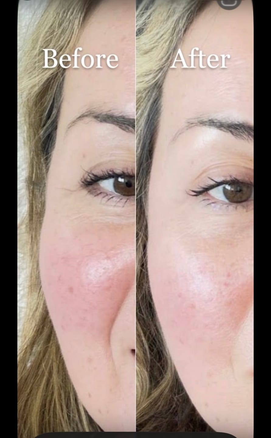 Customer photo review of TV-Set 2 I Serum + Microinfusion-System