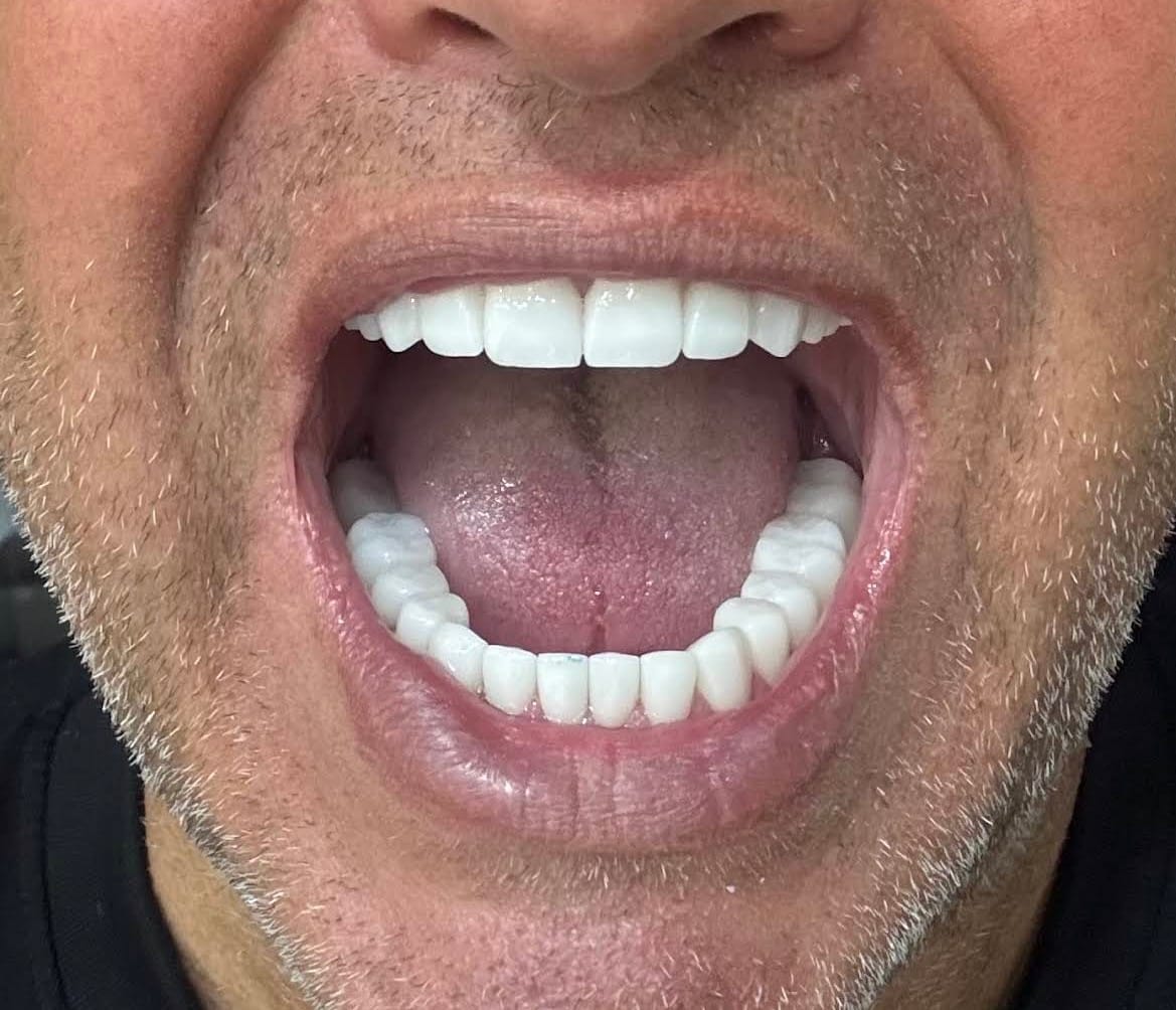 Customer photo review of Veneers, Crowns & Composite Ultimate Smile Care Bundle