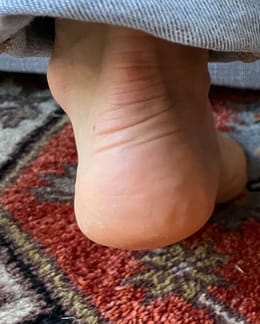Customer photo review of Fotvårdsstift för torra och spruckna hälar