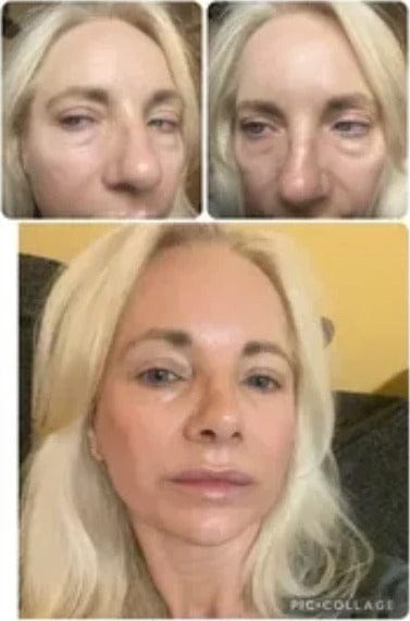 Customer photo review of PHISMA™ Luz Roja 630 nm + EMS para el contorno de ojos