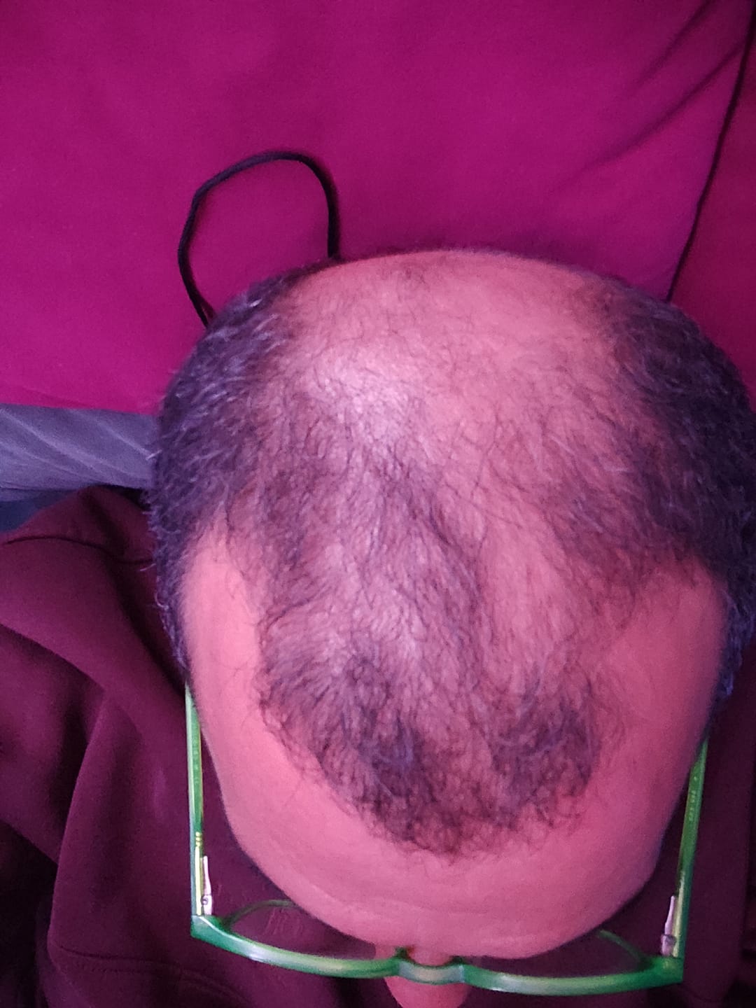 Customer photo review of DHT Blocker : Bloqueur de DHT Naturel | Saw Palmetto 320 mg | Max-Barber