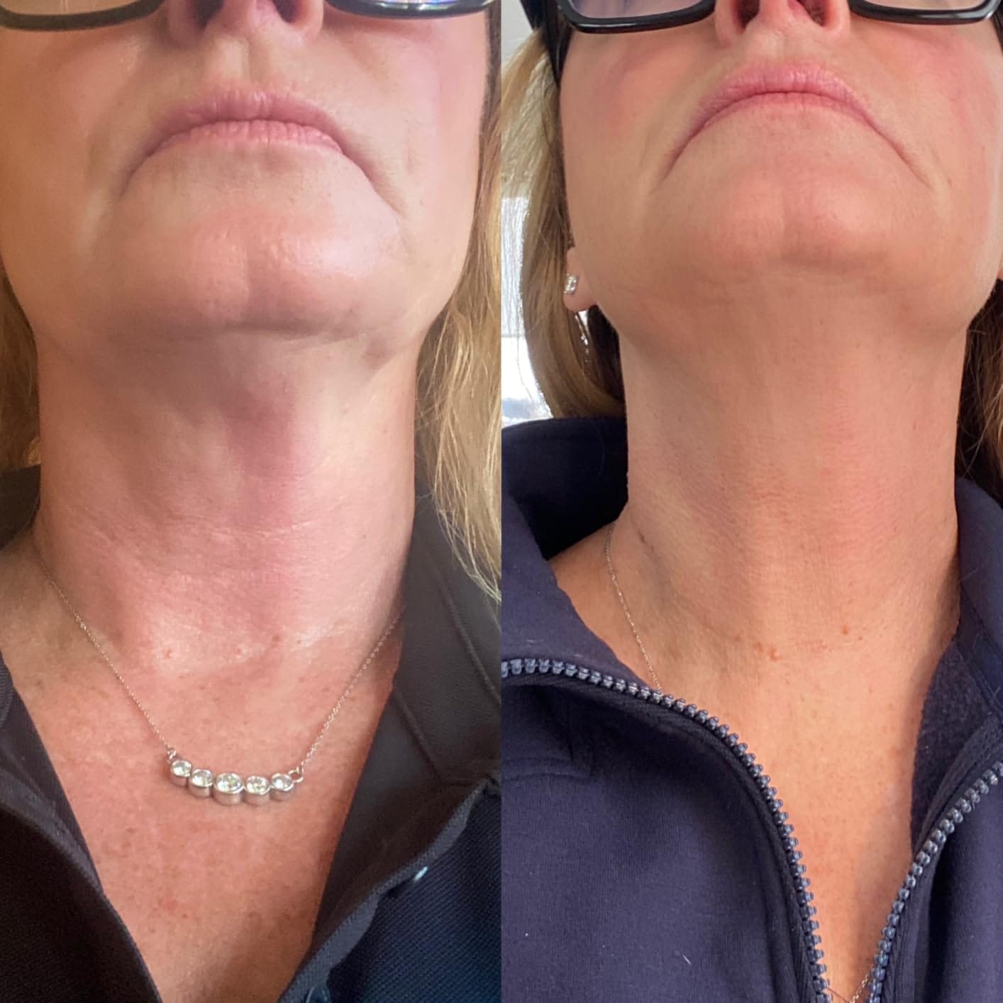 Customer photo review of Organix™ - Tighten & Lift Neck & Chest Moisturizer Cream