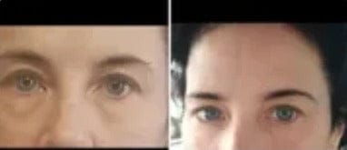 Customer photo review of PHISMA™ Luz Roja 630 nm + EMS para el contorno de ojos