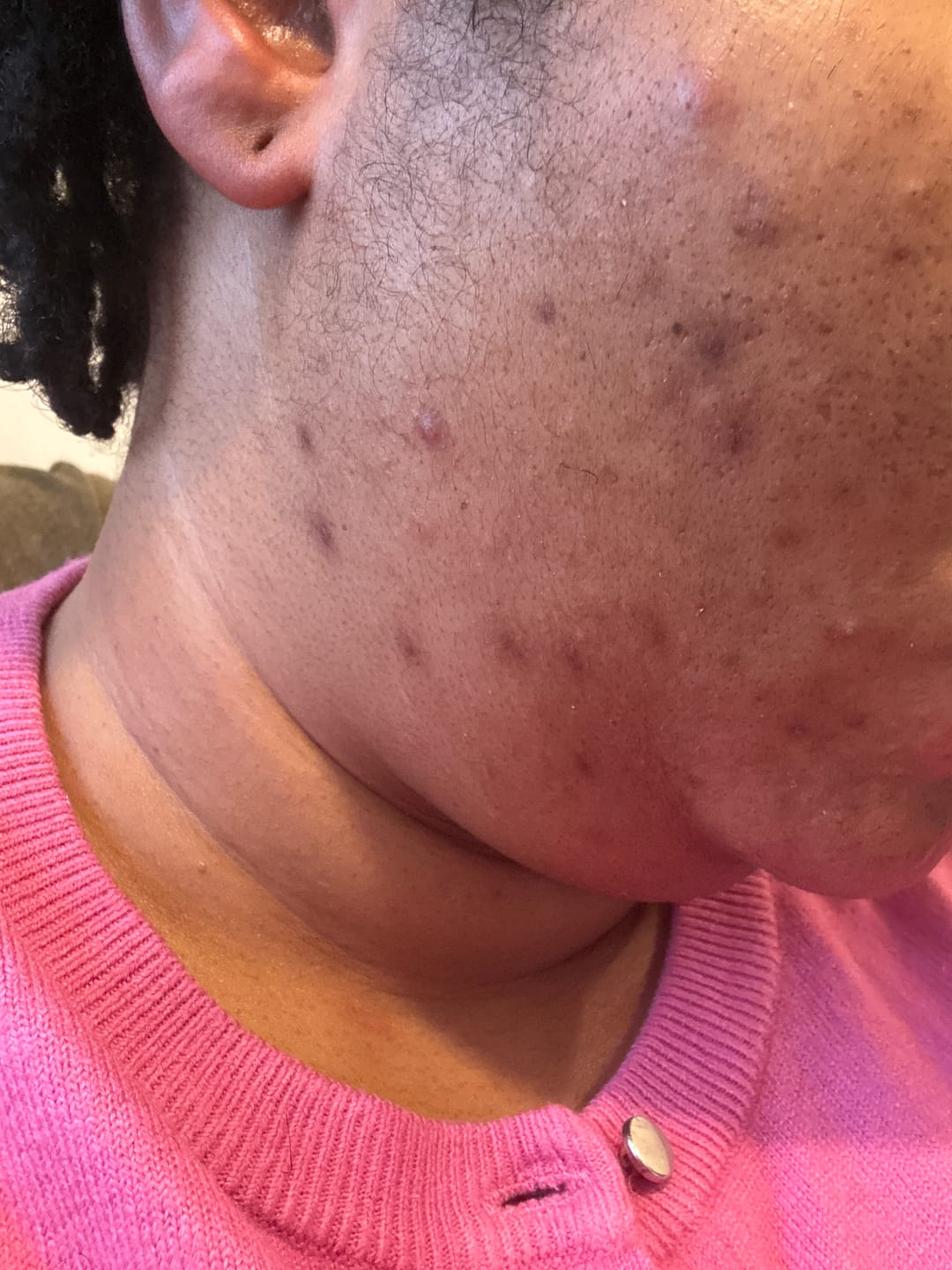 Customer photo review of Mira Lightening Face Black Soap