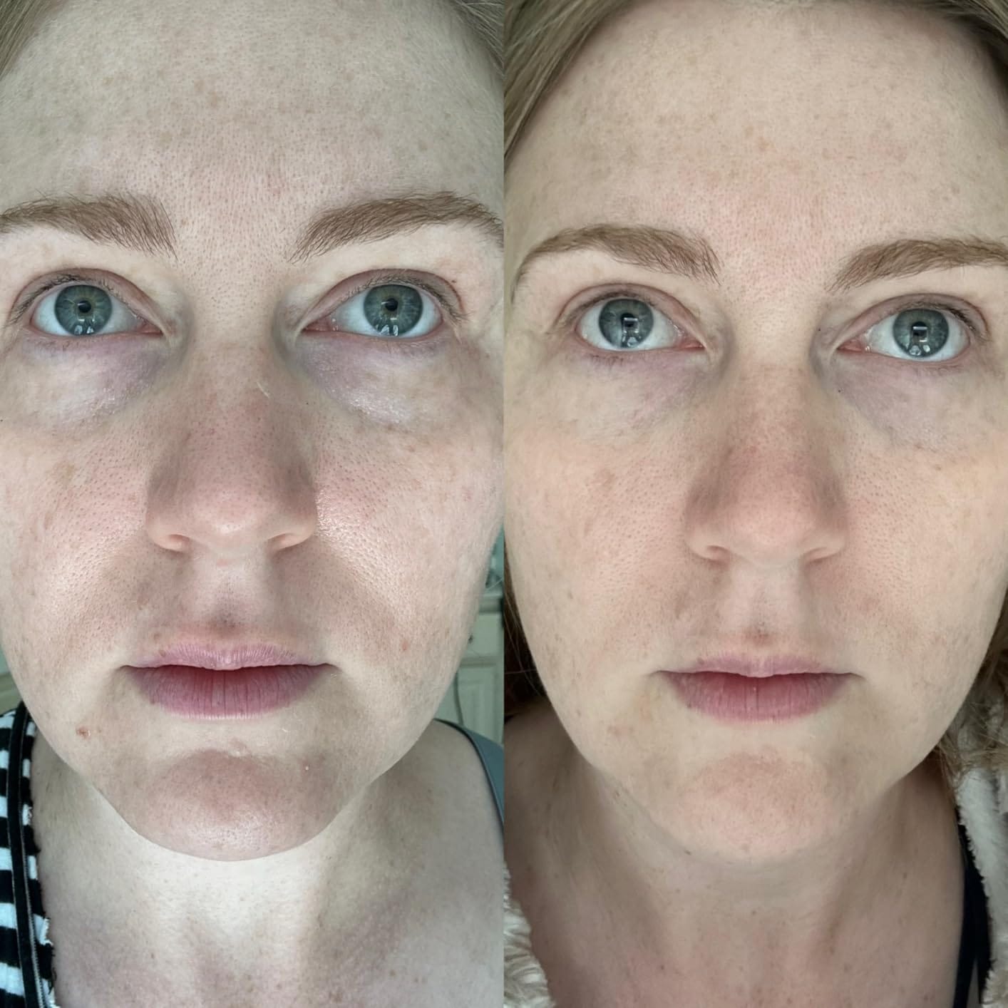 Customer photo review of Organix™ - Instant Puffy Under Eye Bag Remover Cream