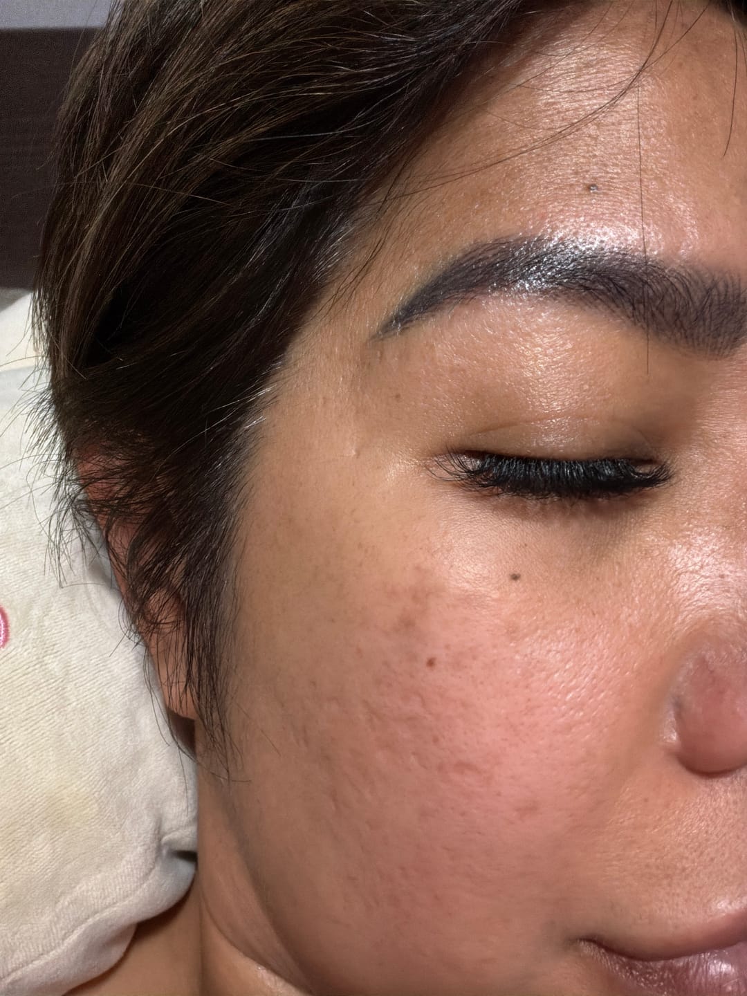 Customer photo review of Ventamin Light Up: Doctor-Formulated Brightening Formula for Melasma, Acne scars & Hyperpigmentation