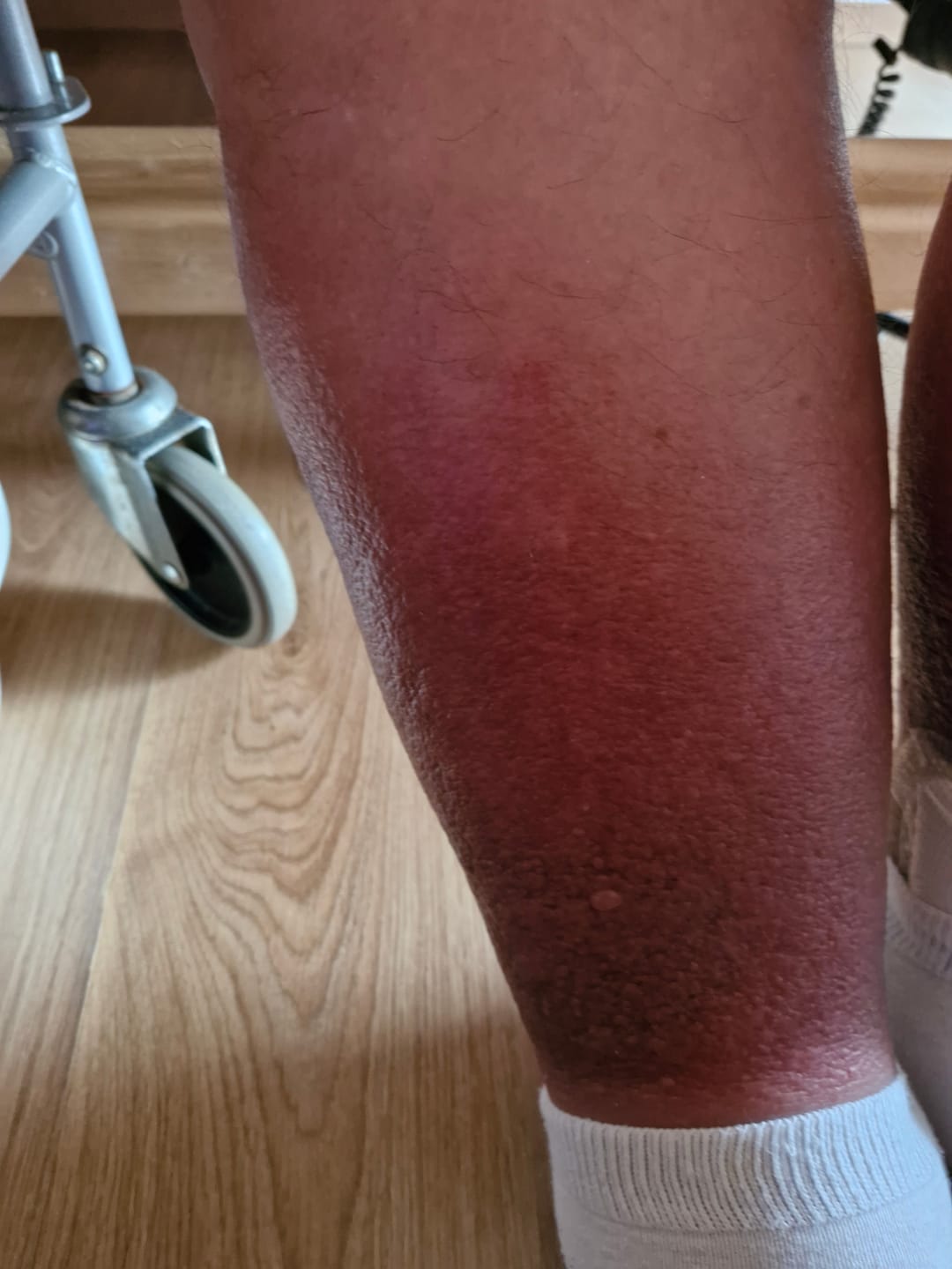 Customer photo review of Duftstofffreie, nicht fettende Anti-Juckreiz-Lotion mit Ceramid NP für trockene, gerötete und empfindliche Haut