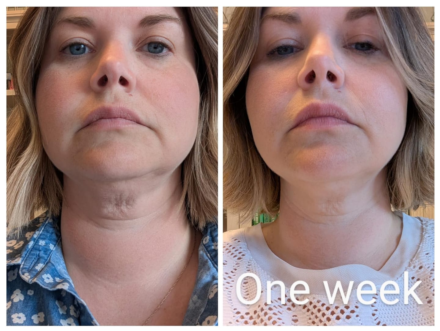 Customer photo review of Organix™ - Instant Puffy Under Eye Bag Remover Cream