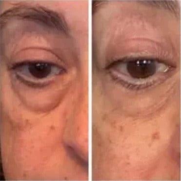 Customer photo review of PHISMA™ Luz Roja 630 nm + EMS para el contorno de ojos