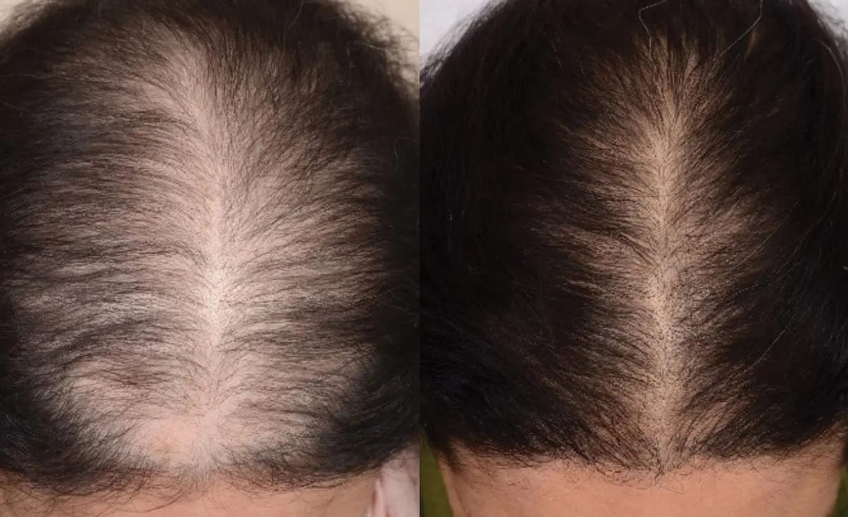 Customer photo review of PDRN Shoot Brush 2x1 Oferta