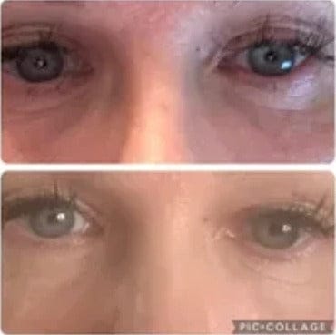 Customer photo review of PHISMA™ Luz Roja 630 nm + EMS para el contorno de ojos
