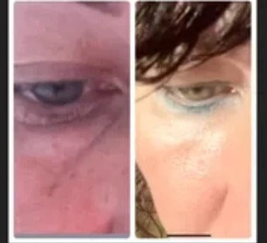 Customer photo review of PHISMA™ Luz Roja 630 nm + EMS para el contorno de ojos