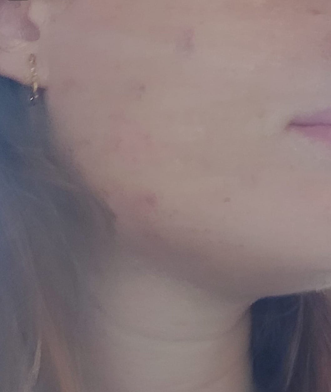 Customer photo review of Acne Care Phage Gel – gel pentru tenul cu tendință acneică