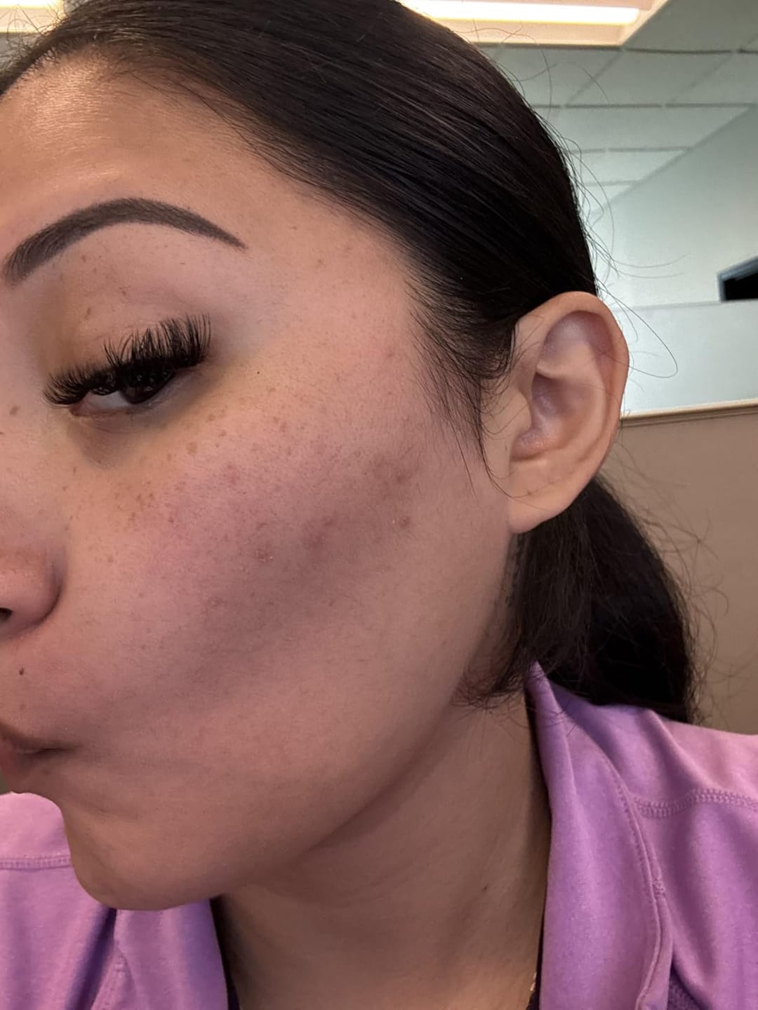 Customer photo review of Advanced Acne Clear Program™