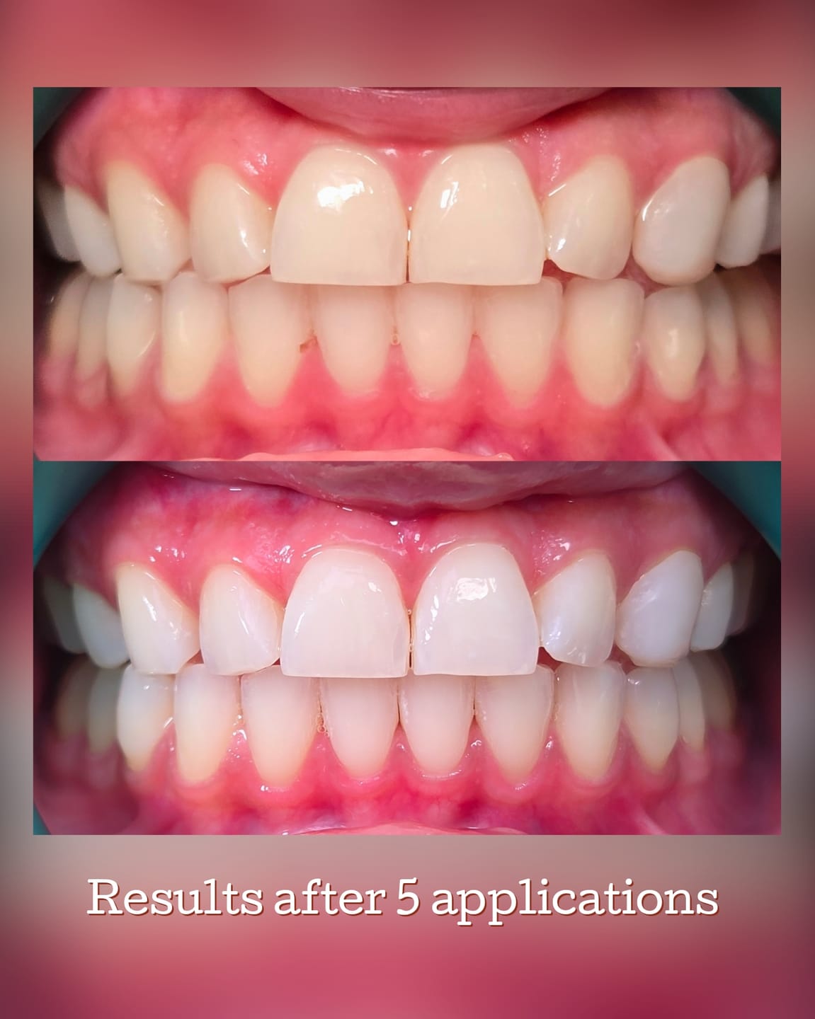Customer photo review of TEETH WHITENING KIT