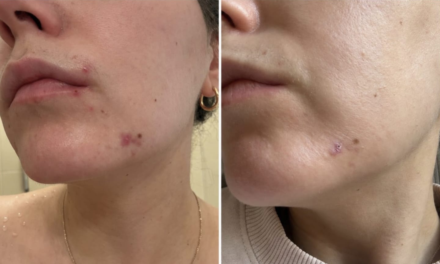 Customer photo review of Acne Care Phage Gel – gel pentru tenul cu tendință acneică
