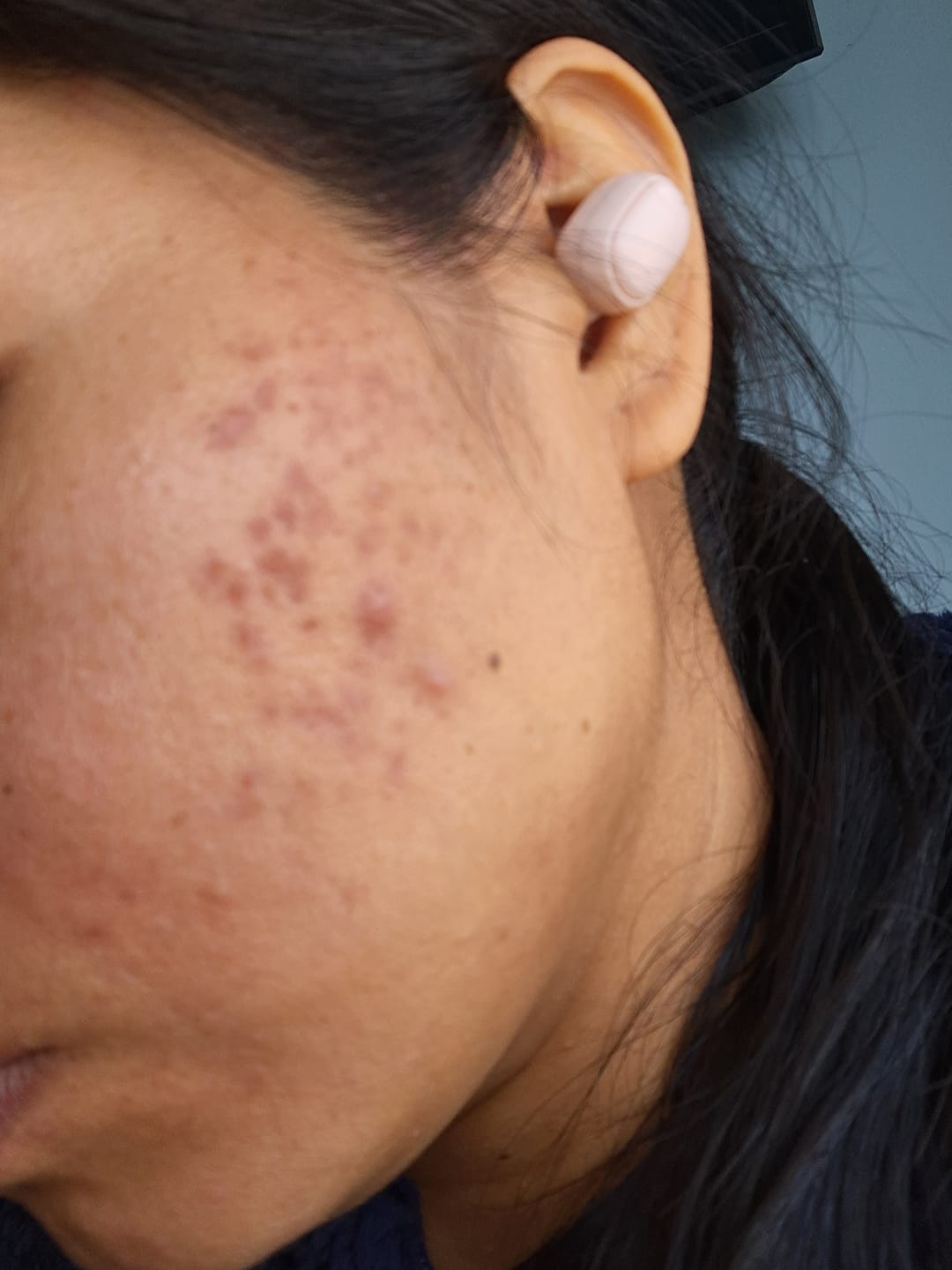 Customer photo review of Sérum Facial Despigmentante Anti Manchas AMPLEN 30ml