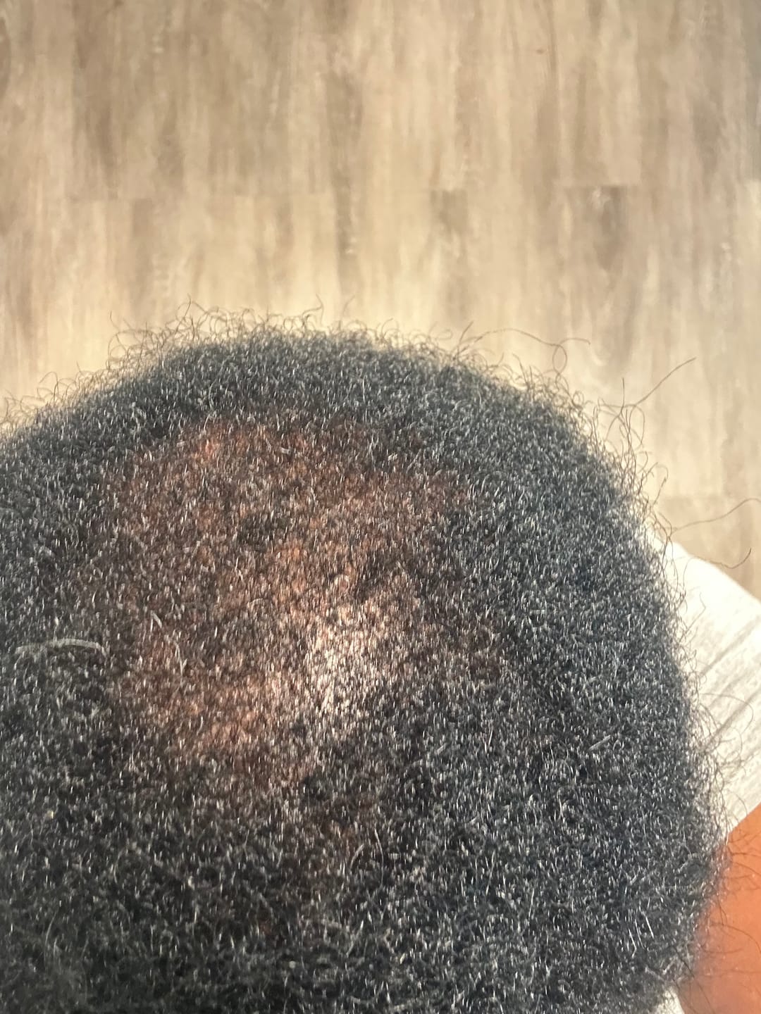 Customer photo review of Scalp Therapy System
