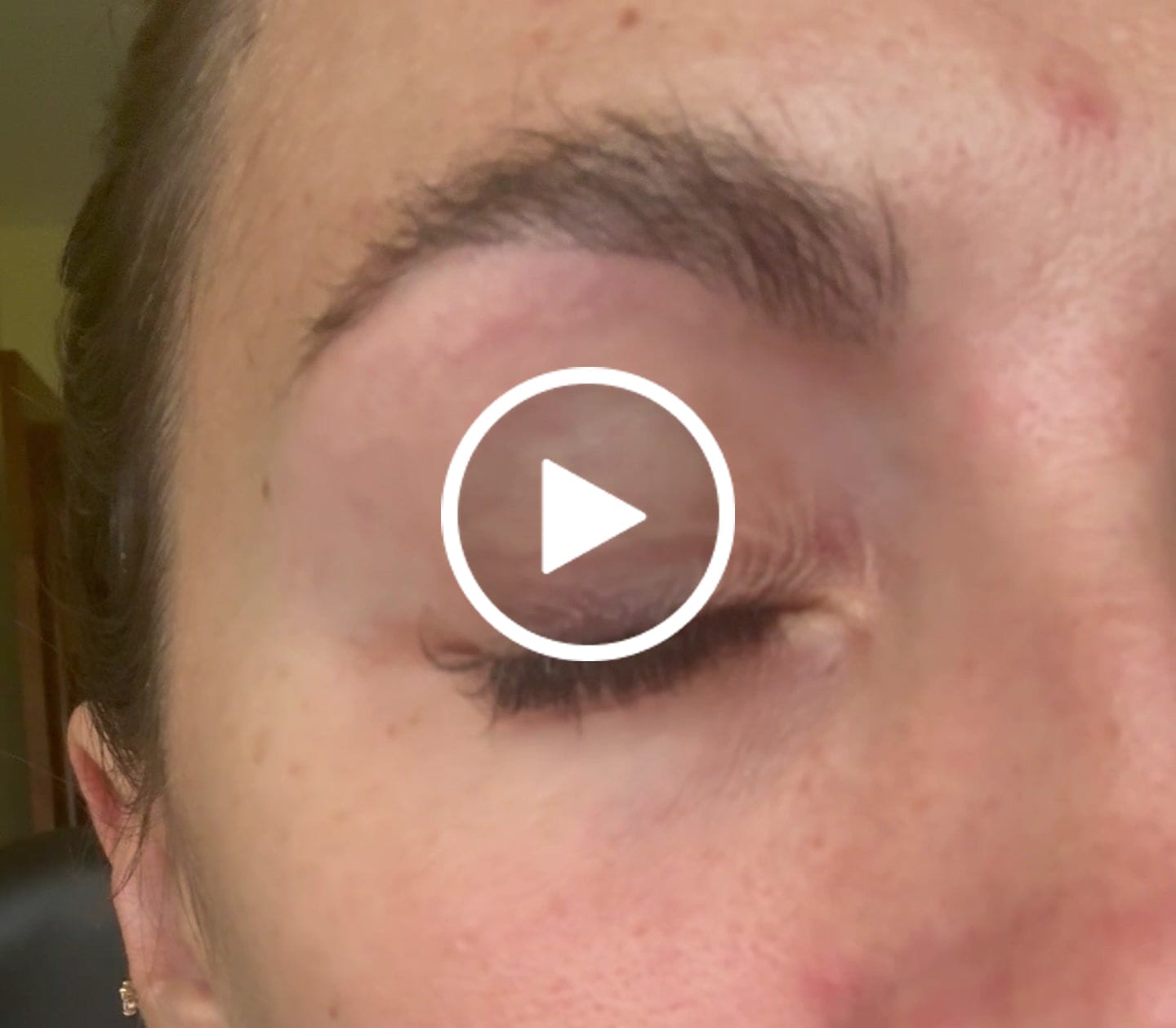 Customer video review of Parches hydrogel 1 par