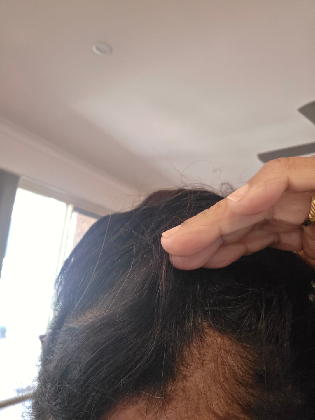 Customer photo review of Advance Hair Growth Serum 2.0 (30ml)