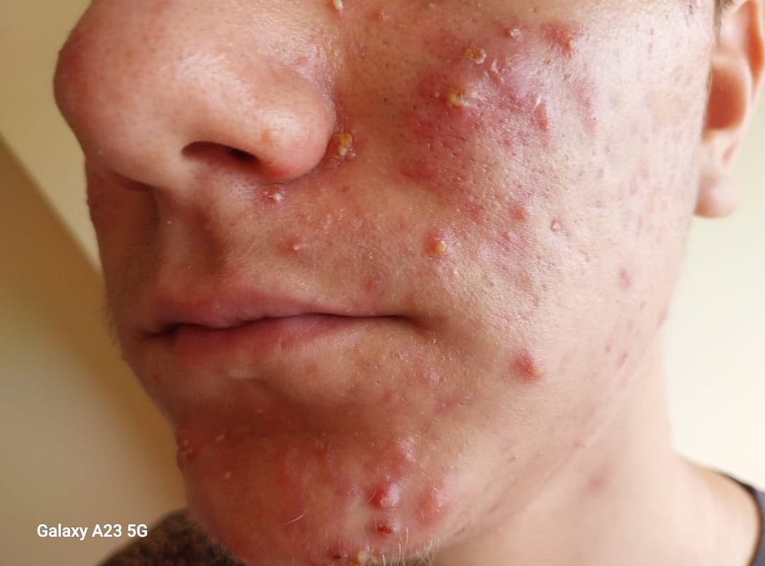 Customer photo review of Acne Care Phage Gel – gel pentru tenul cu tendință acneică